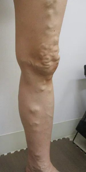 伏在静脈瘤 治療前