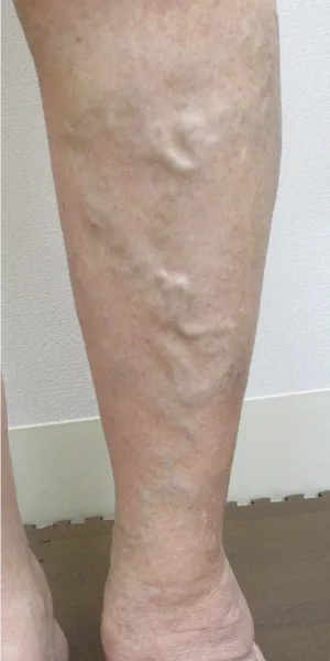 側枝静脈瘤 治療前