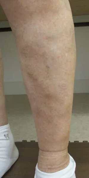 側枝静脈瘤 治療後