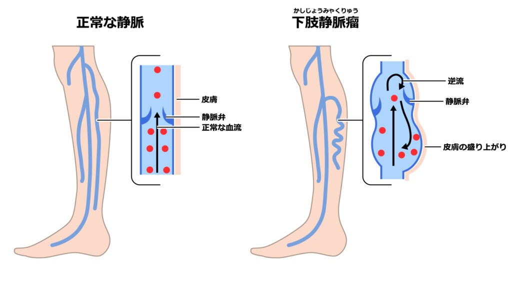 そもそも下肢静脈瘤とは？
