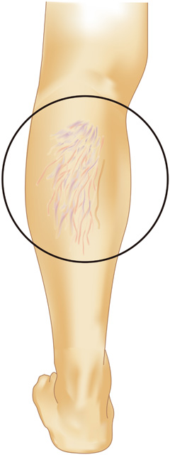 クモの巣状静脈瘤